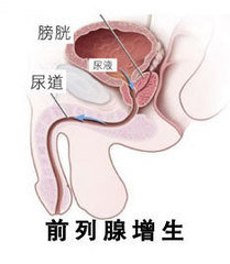 前列腺增生